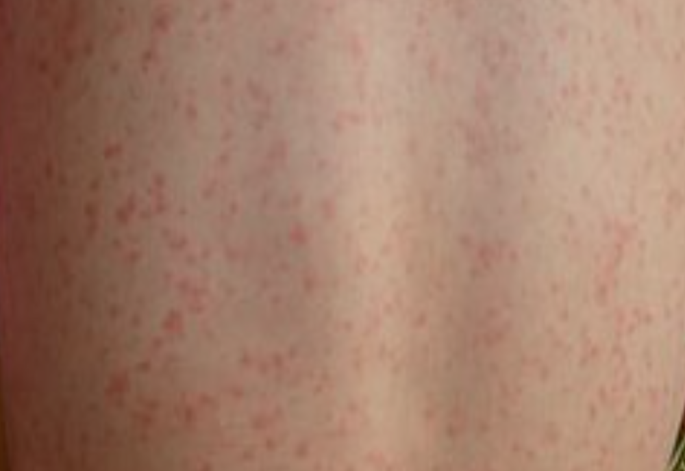 Numărul cazurilor de SCARLATINĂ, în creștere alarmantă, în România