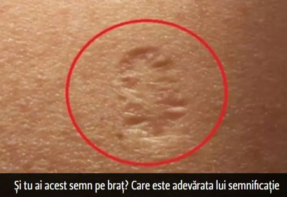 Și tu ai acest semn pe braț? Care este adevărata lui semnificație: ni s-a spus că e de la vaccin, dar…